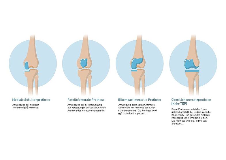 Schematische Darstellung von Knieprothesen-Typen