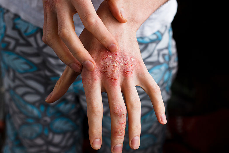 Person kratzt sich an einer Hand, welche betroffen von einer rheumatischen Schuppenflechte ist.