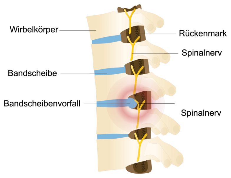 Rückenschmerzen - Anzeichen, Ursachen, Therapie, Reha